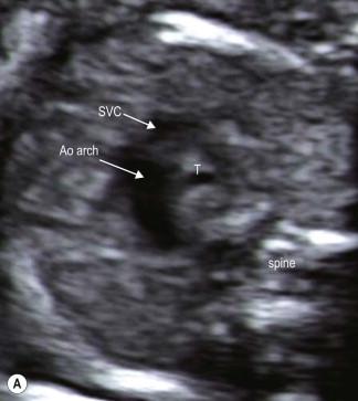 FIGURE 14-17, (A) Directing the ultrasound beam cranial to the three-vessel view will demonstrate the transverse arch, the most superior arterial vessel, crossing the midline in front of the trachea from right to left. (B) Colour Doppler confirms forward flow in the transverse arch.