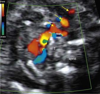 FIGURE 14-19, The horizontal view in the upper thorax, just above the aortic arch, showing the subclavian arteries arising from the aortic arch in long axis in front of the trachea. Yellow arrows indicate the tortuous right subclavian artery.