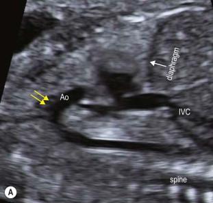 FIGURE 14-20, (A) A longitudinal view demonstrates the aortic arch and the head and neck vessels (yellow arrows). (B) Colour Doppler confirms normal flow pattern within aorta and inferior vena cava.