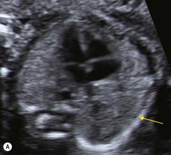 FIGURE 14-2, (A) The correct horizonal plane demonstrates a circular shape of the thorax and one nearly complete rib (yellow arrow). (B) An oblique section across the thorax demonstrates multiple ribs (red arrows); in this plane, the heart cannot be adequately analyzed.