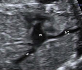 FIGURE 14-21, A longitudinal plane of the fetus shows the inferior vena cava and the superior vena cava draining into the right atrium.