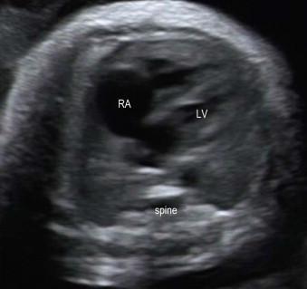 FIGURE 14-23, The fetal heart is seen in a four-chamber view. The heart appears enlarged with right heart dominance. This was due to intrauterine growth retardation.