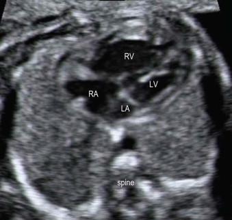 FIGURE 14-24, The fetal heart is seen in an apical four-chamber view. There is moderate ventricular disproportion in this fetus at 20 weeks' gestation. This picture is suggestive of coarctation of the aorta.