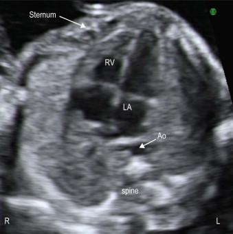 FIGURE 14-3, The spine should be located, then the anterior chest wall (Sternum), which is opposite the spine. The right ventricle lies beneath the anterior chest wall. The descending aorta is seen as a circular structure lying anterior to the spine. Anterior to the spine is the left atrium. The right atrium is the only chamber located in the right thorax. The left ventricle lies posterior to the right ventricle.