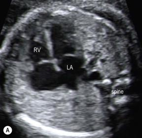 FIGURE 14-4, (A) The heart is seen in an apical four-chamber view. (B) The heart is seen in a lateral four-chamber view. This is the best orientation for examining the ventricular septum. (C) The heart is seen in a ‘back up’ four-chamber view, the least favourable fetal position. The appearance of the four-chamber view varies according to the fetal position. However, the method of orientation starting from the spine should be the same, and the four features of normality can be evaluated.