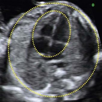 FIGURE 14-5, The heart is seen in an apical four-chamber view. It occupies about one-third of the thorax. If the circumferences are measured, the normal cardiothoracic ratio is 0.55 ± 0.05.