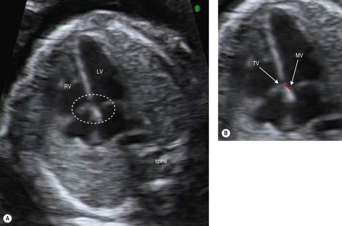 FIGURE 14-8, The fetal heart is seen in an apical four-chamber view. The crux of the heart (A, dashed circle) is zoomed to emphasize the ‘off-setting’ of the atrioventricular valves. The slight difference in the level of the valves is denoted by red line (B). The septal leaflet of the tricuspid valve (TV) is inserted lower in the ventricular septum than the mitral valve (MV). Note the ventricular septum appears intact from apex to crux.