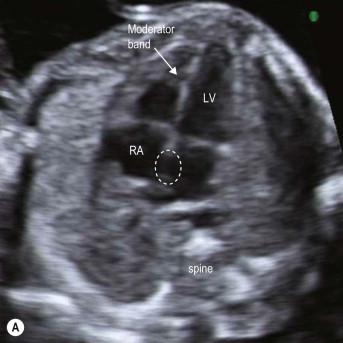 FIGURE 14-9, The fetal heart is seen in an apical four-chamber view. (A) The foramen ovale (dashed circle) occupies about one-third of the atrial septum. (B) The primum septum (dashed, yellow arrow) forms the crux of the heart. The posterior third of the atrial septum is well seen in this example.