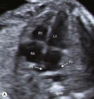 FIGURE 14-10, (A) The fetal heart is seen in a four-chamber view. The right and left pulmonary veins (PV) are seen connecting to the back of the left atrium on either side of the descending aorta on the 2D image. (B) Two pulmonary veins can be seen to be draining into the left atrium on colour flow mapping.