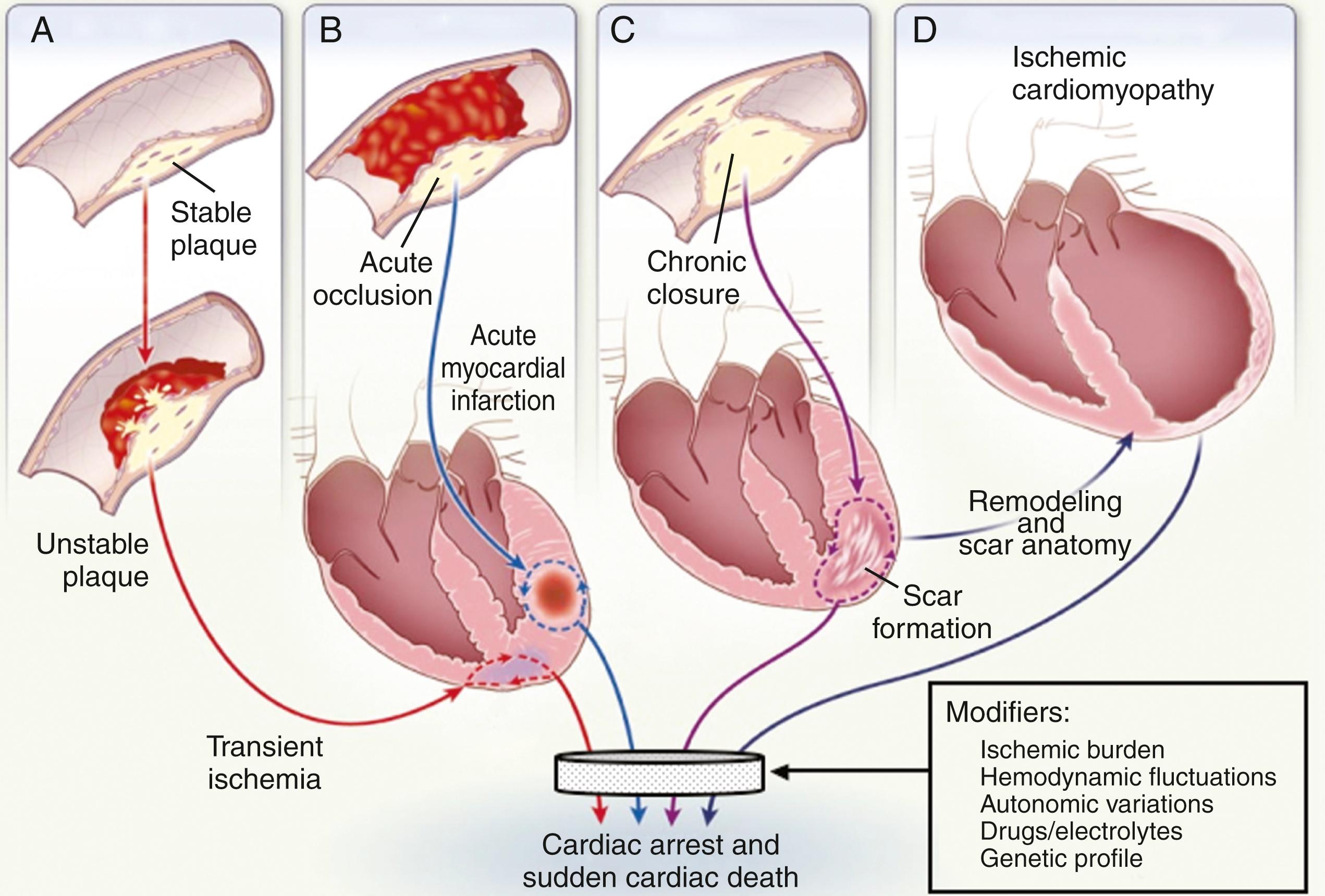 FIGURE 70.7, Pathophysiology of ventricular tachyarrhythmias in coronary heart disease.