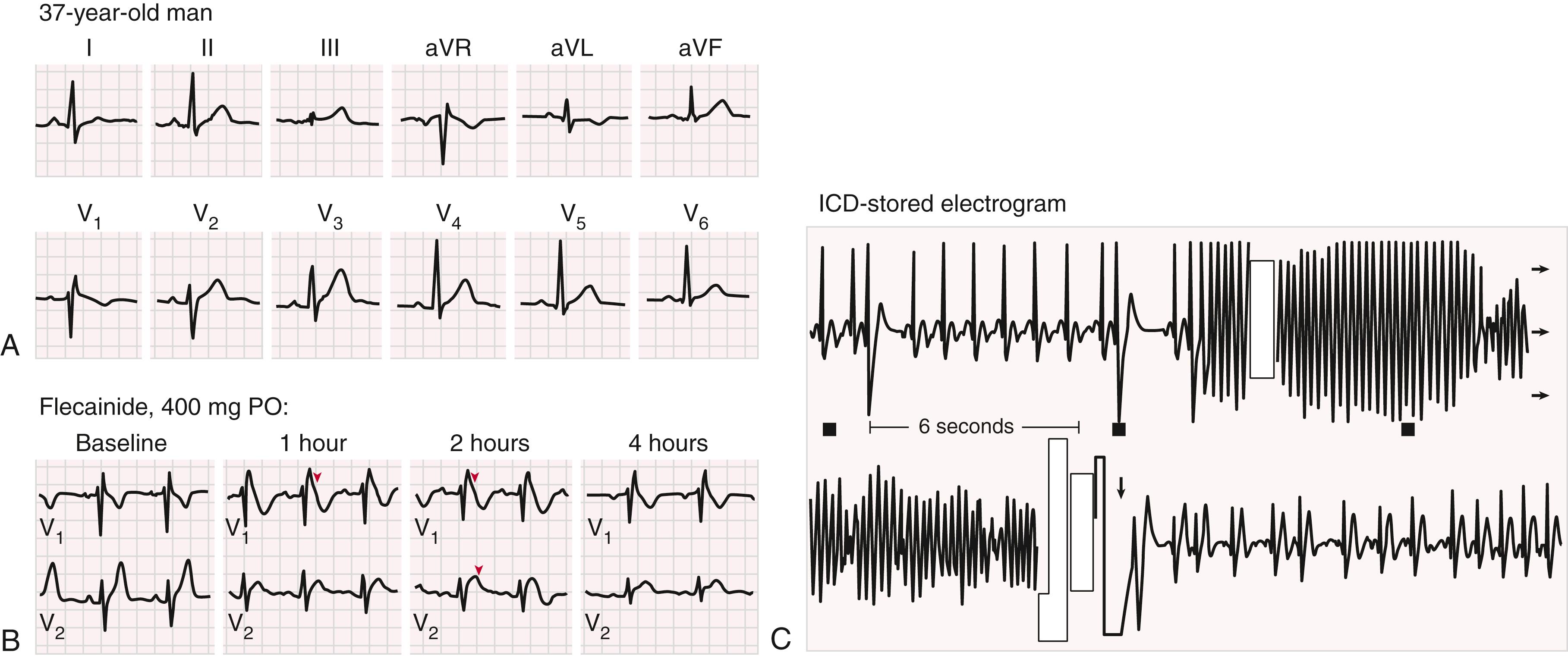 FIGURE 70.9, Electrocardiographic and clinical findings in a 37-year-old man with Brugada syndrome.