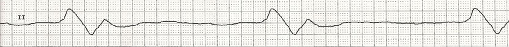 Fig. 14.1, Sine wave of hyperkalemia seen on the cardiac monitor during cardiopulmonary resuscitation.