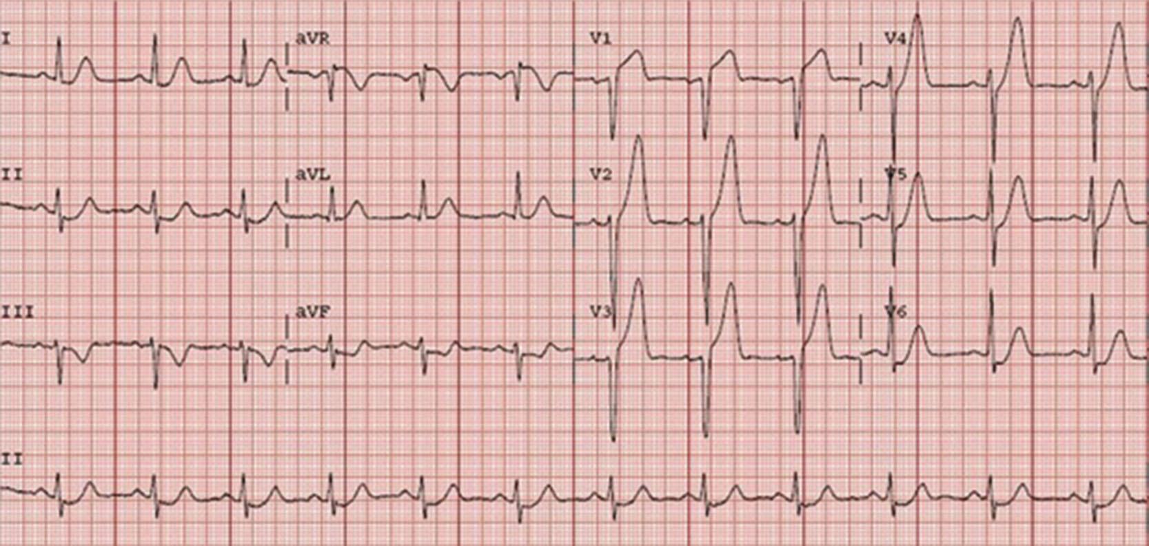 Fig. 14.2, Post-return of spontaneous circulation electrocardiogram showing peaked T waves in the precordial leads.