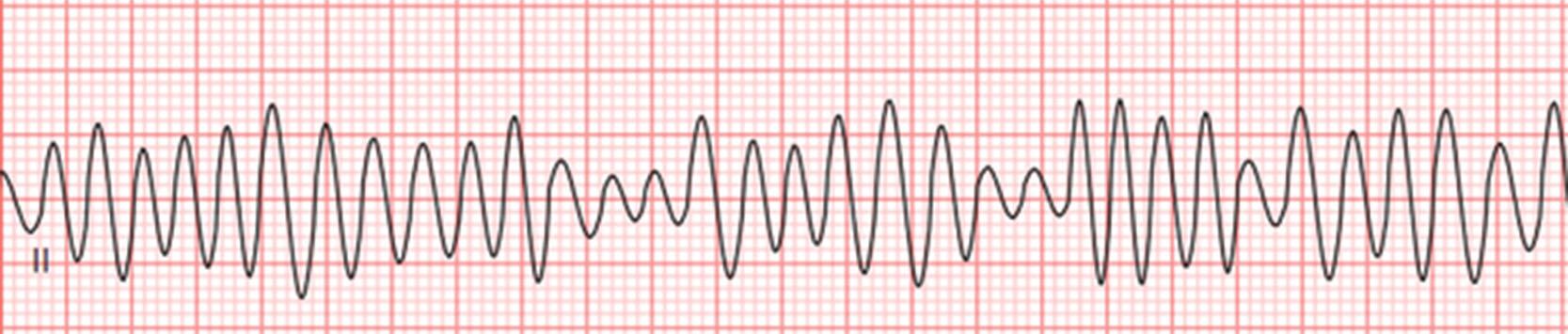 Fig. 15.1, Telemetry strip showing coarse ventricular fibrillation.