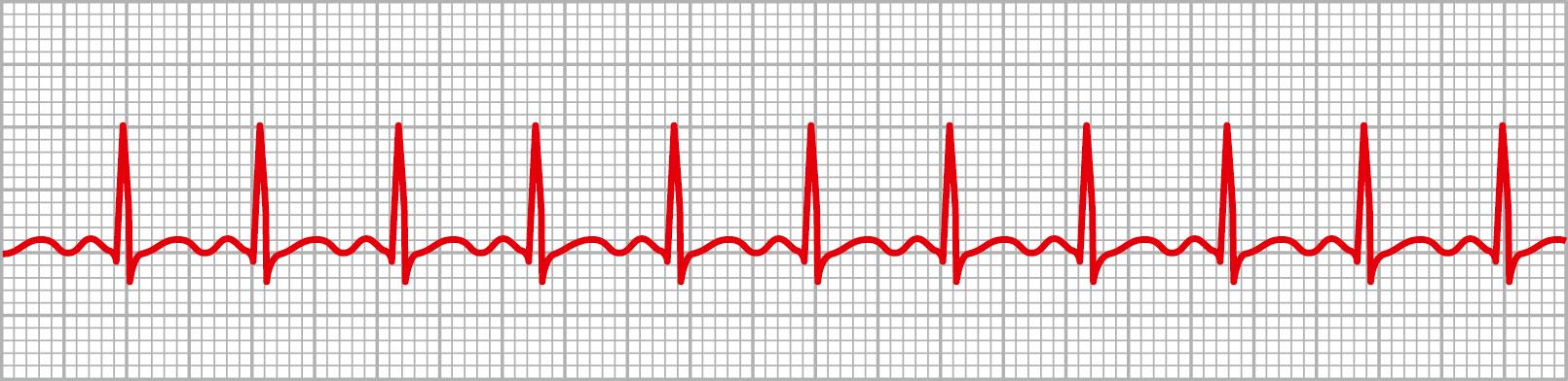 Figure 13-1, Sinus tachycardia (lead I).