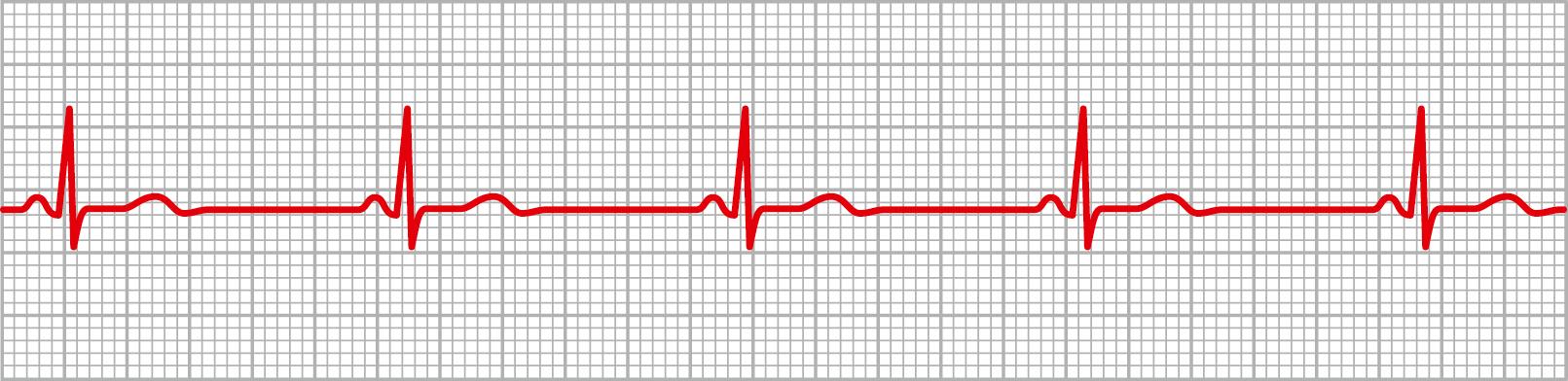 Figure 13-2, Sinus bradycardia (lead III).