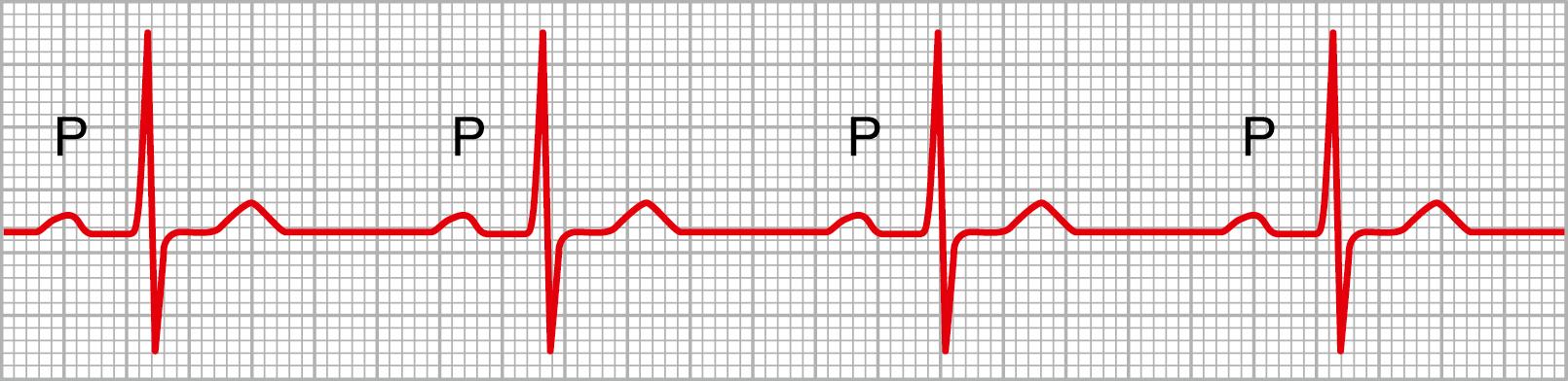 Figure 13-5, Prolonged P-R interval caused by first-degree atrioventricular heart block (lead II).
