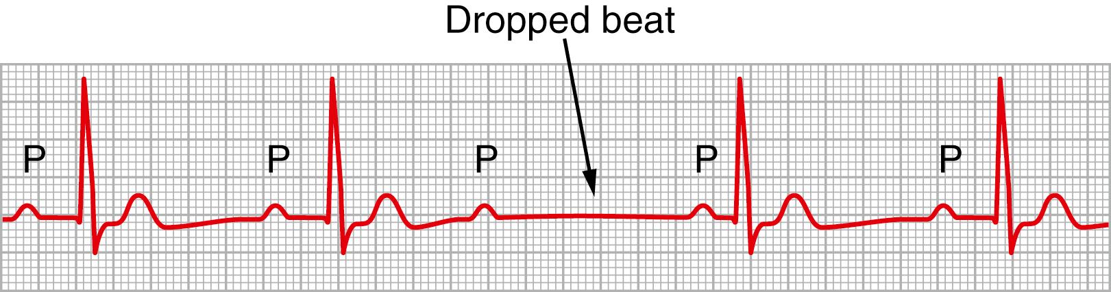 Figure 13-6, Type I second-degree atrioventricular block showing progressive P-R prolongation prior to the dropped beat.