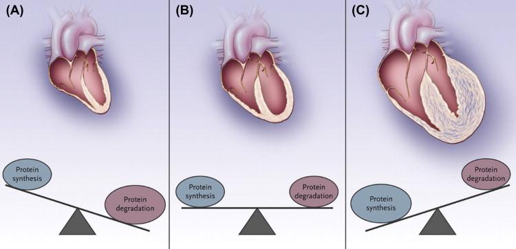 FIGURE 3.1, Cardiac remodeling involves increased and decreased growth mediated by an imbalance between protein synthesis and degradation. (A) In atrophic remodeling, protein degradation is favored to produce smaller cardiomyocytes and reduced myocardial size. (B) In the healthy heart, protein synthesis is balanced by protein degradation such that they occur equally and simultaneously. (C) In the hypertrophic heart, protein synthesis outweighs protein degradation to increase cardiomyocyte and myocardial size.