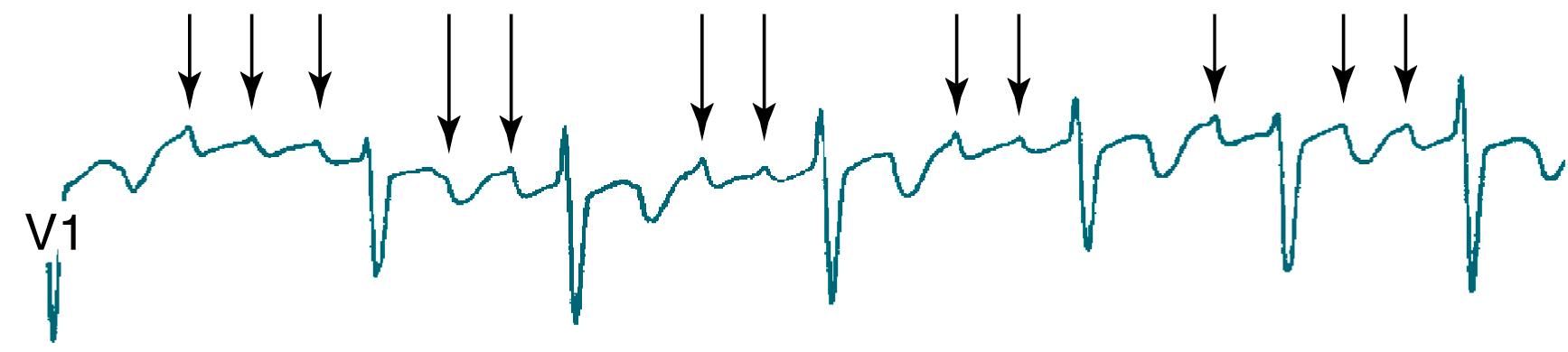 Fig. 3.2, Rhythm strip from a 17-year-old boy with Duchenne muscular dystrophy. The strip shows atrial flutter, with the ( arrows ) pointing to visible flutter waves at a rate of approximately 300 beats per minute. The atrioventricular node has variable conduction, with a ventricular rate of approximately 80 to 110 beats per minute.