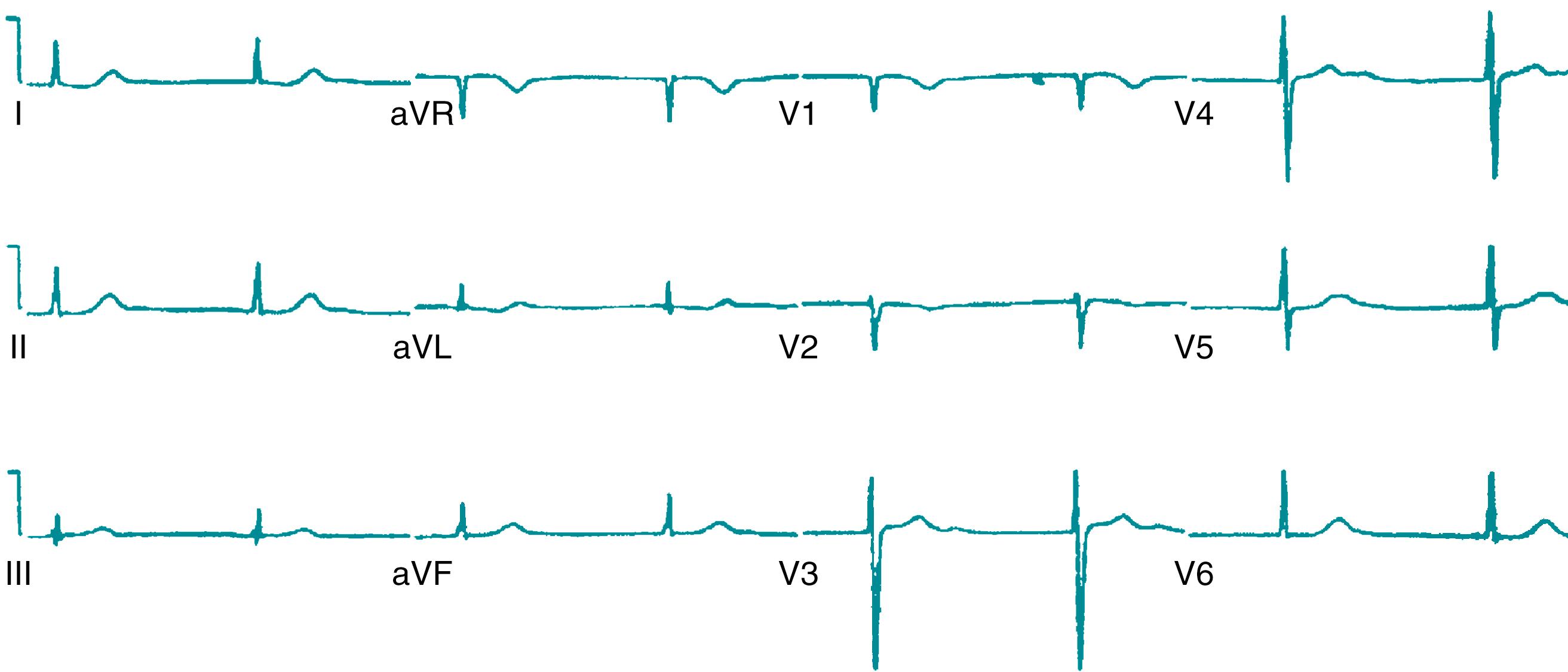 Fig. 3.3, Electrocardiogram from a 19-year-old man with myotonic dystrophy type I. The tracing shows atrial standstill. There are no P waves evident, and there is a junctional rhythm at approximately 45 beats per minute.