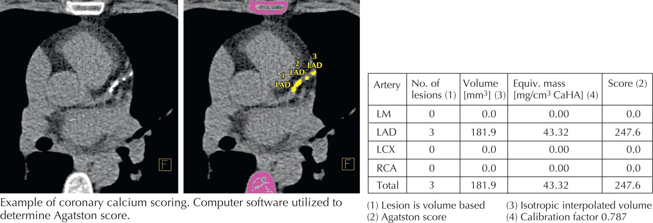 FIG 11.1, Coronary calcium scoring. LAD , Left anterior descending; LCX , left circumflex; LM , left main; RCA , right coronary artery.