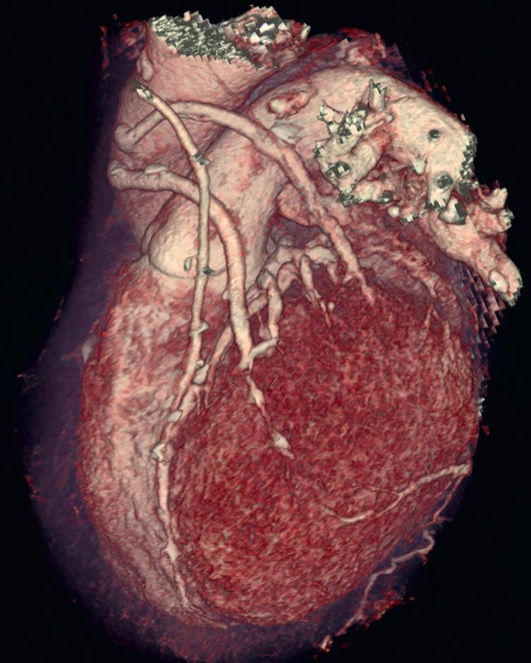 FIG 11.2, Three-dimensional cardiac computed tomography volume rendering showing patent bypass grafts.