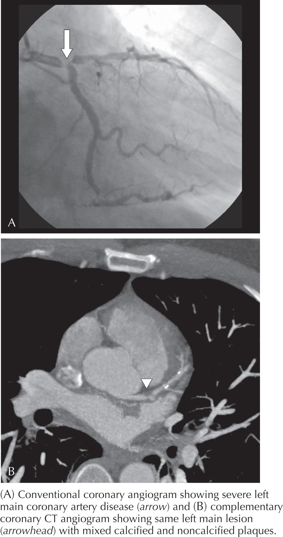 FIG 11.3, Conventional diagnostic coronary angiogram and coronary CT angiogram.