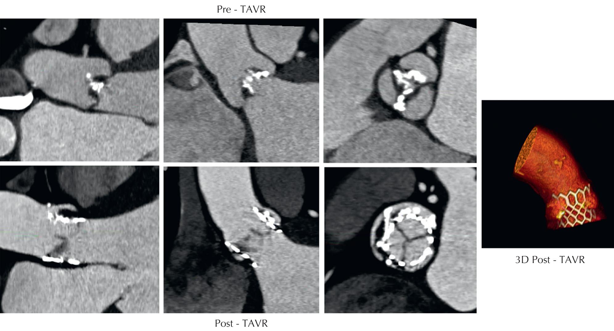 FIG 11.4, Cardiac CT images pretranscatheter and posttranscatheter aortic valve replacement (TAVR). 3D , Three-dimensional.