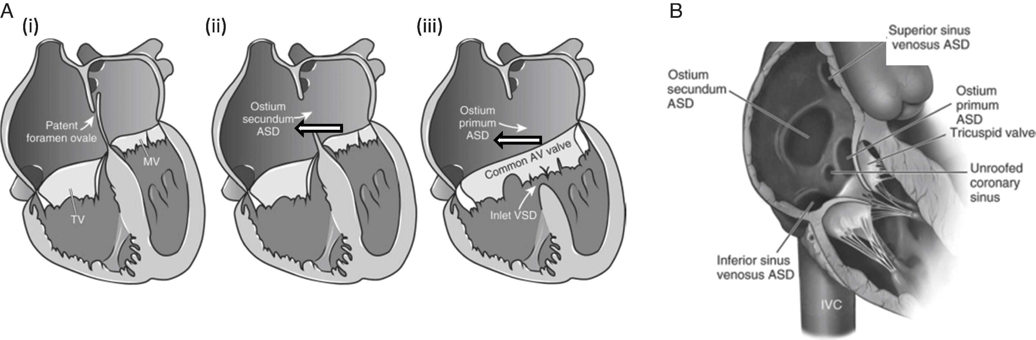 Fig. 37.1, (A) Schematic of atrial level shunts. (i) Patent foramen ovale; (ii) ostium secundum atrial septal defect (ASD); (iii) ostium primum ASD with a common atrioventricular (AV) valve and associated inlet ventricular septal defect (VSD). (B) Right atrial view of the interatrial septum demonstrating the location of different types of ASD. Ao, Aorta; IVC, inferior vena cava; MV, mitral valve; SVC, superior vena cava; TV, tricuspid valve. (Reproduced with permission and minor modifications from Lin J, Aboulhosn JA: Congenital shunts. In: Otto CM, ed. The Practice of Clinical Echocardiography , 5th ed. Philadelphia: Elsevier; 2017:881–883, Fig. 44.2–44.3.)