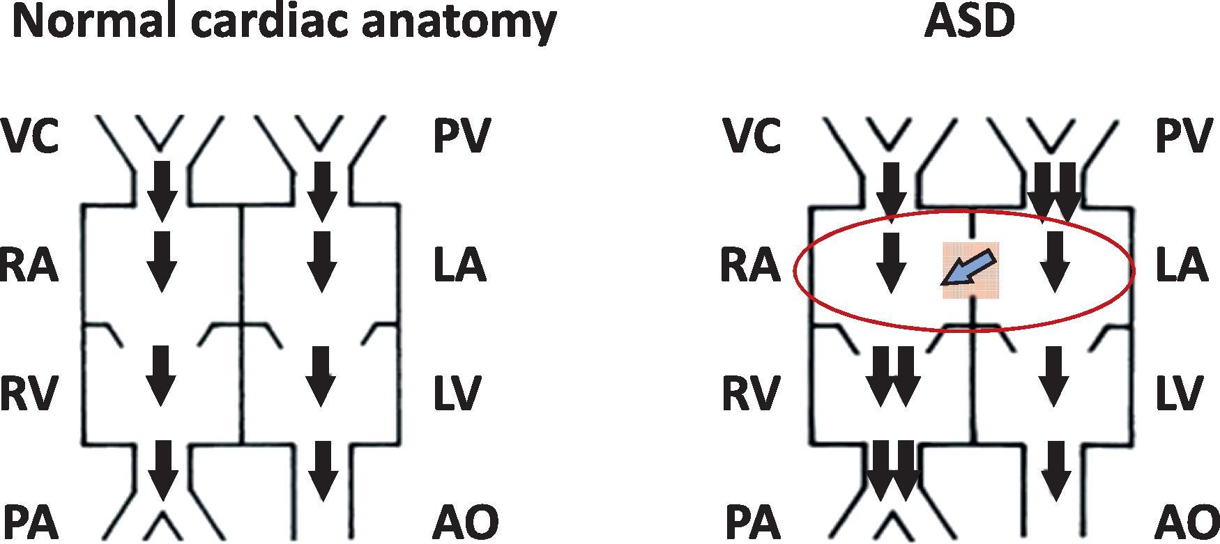 Fig. 37.2, Pathophysiology of Atrial Septal Defects (ASDs). Some of the pulmonary venous blood entering the left atrium (LA) flows left-to-right (L→R) through the ASD into the right atrium (RA) and right ventricle (RV). The degree of L→R shunting is determined by the compliance of the “downstream” RV. L→R shunting is low in neonates with poor RV compliance. It increases once the pulmonary vascular resistance (PVR) drops and the RV compliance improves. Most shunting occurs in diastole and during expiration. Most ASDs do not become symptomatic in neonates. Symptoms related to ASDs are usually related to long-standing large L→R shunting, which cause volume overloading in the RV. Patients with ASDs are at risk for paradoxical embolism. The second heart sound (S2) and its variations with respiration are lost because of increased RV volume. This is heard as wide, fixed splitting of S2 on auscultation. Increased blood flow through the tricuspid valve causes a systolic ejection murmur.