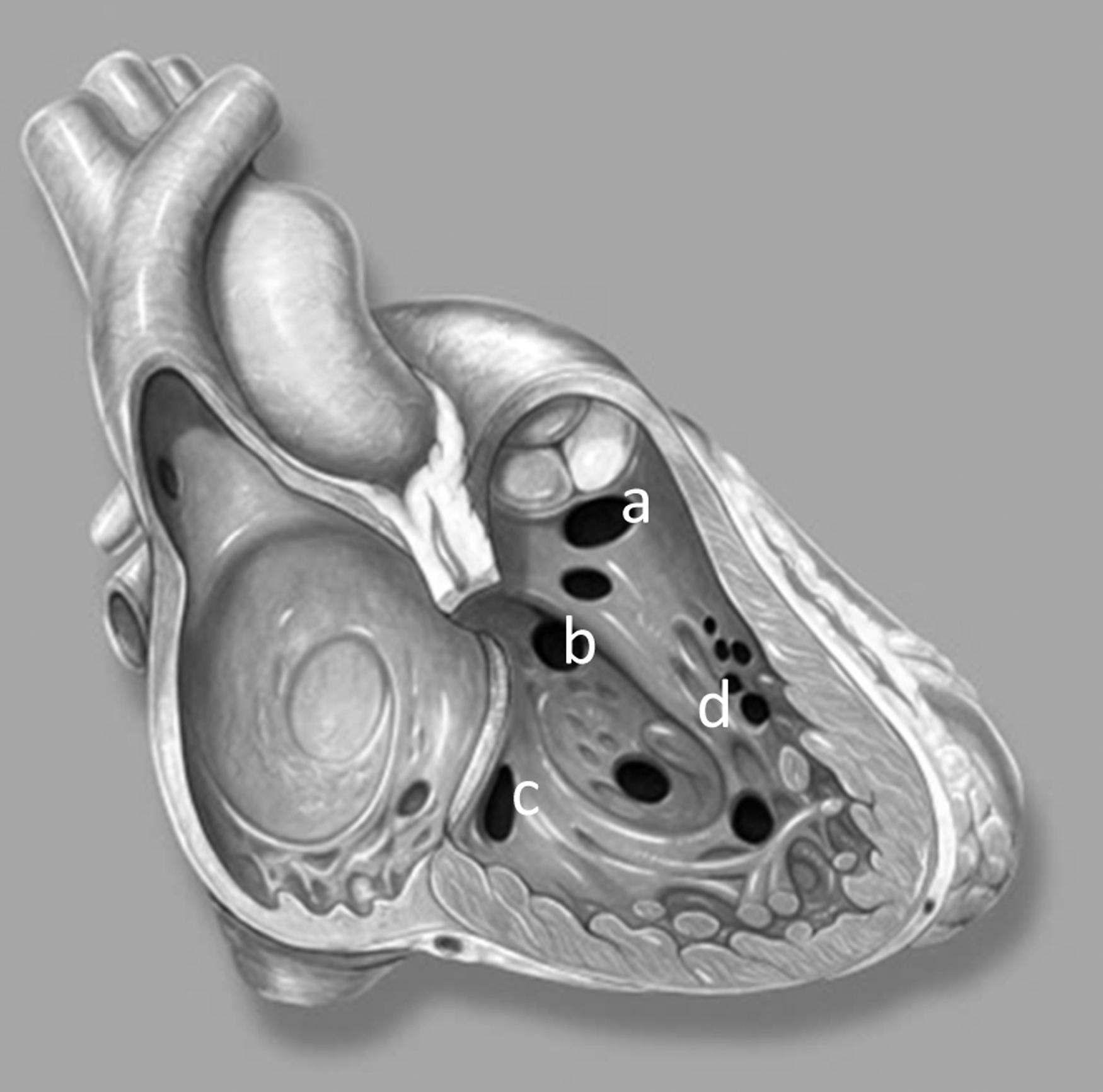 Fig. 37.3, Ventricular Septal Defect (VSD). VSDs classified based on location: (a) outlet; (b) perimembranous; (c) inlet; and (d) muscular. (Lynch PJ, illustrator; Jaffe CC, cardiologist; Yale University Center for Advanced Instructional Media Medical Illustrations by Patrick Lynch, generated for multimedia teaching projects by the Yale University School of Medicine, Center for Advanced Instructional Media, 1987–2000. Lynch PJ, http://patricklynch.net; http://commons.wikimedia.org/wiki/File:Heart_right_vsd.jpg. From Steppan and Maxwell. Congenital heart disease. In: Stoelting’s Anesthesia and Co-Existing Disease , chap 7, 129–149.)