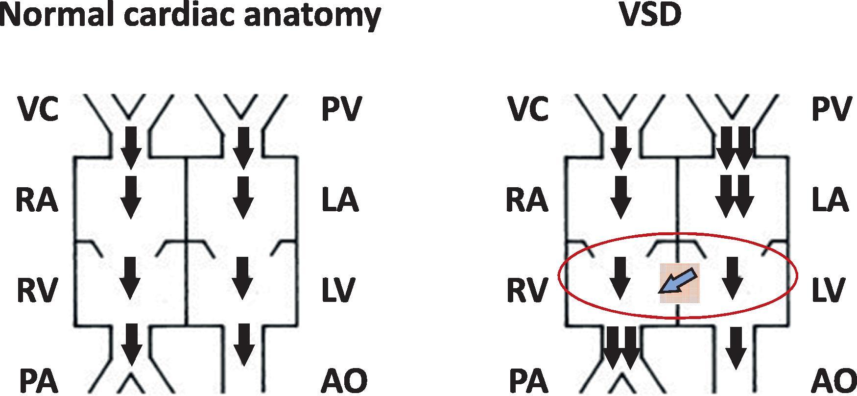 Fig. 37.4, Pathophysiology of Ventricular Septal Defects (VSDs). In patients with a VSD, left ventricle (LV) contraction ejects some blood into the aorta and some is shunted left-to-right (L→R) across the VSD into the right ventricle (RV) and pulmonary artery (blue arrow) . Severity of L→R shunting is determined by (a) the size of the VSD; and (b) difference in resistance in the pulmonary and systemic vascular circulation. LV hypertrophy occurs to compensate for decreased wall tension and increased output. The hypertrophied LV has decreased compliance and increased end-diastolic pressures. Neonates with VSDs develop symptoms when the pulmonary vascular resistance (PVR) drops with increased L→R shunting and RV/pulmonary blood flow. As pulmonary blood flow increases, the systemic blood flow can become compromised. Increased pulmonary venous return can cause left atrial (LA) pressures, LA dilatation, pulmonary venous congestion, and pulmonary edema.