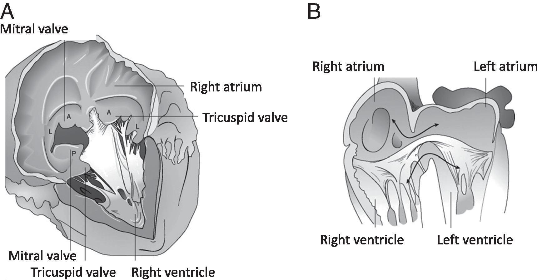 Fig. 37.5, Atrioventricular (AV) Septal Defects (Also Termed as AV Canal Defects). (A) The most frequently seen form of complete AV septal defects (Rastelli type A; details in Fig. 37.6 ) is classified according to (a) the division of the anterior bridging leaflet; and (b) attachment to the septum. The current interpretations emphasize the left-sided portion of anterior leaflet as the anterior bridging leaflet. The right-sided portion is described as the “true” anterior tricuspid leaflet. (B) Schematic 4-chamber view of a complete atrioventricular septal defect, showing common valve and atrial and ventricular communications. A, Two anterior leaflets of the mitral valve (MV) and tricuspid valve (TV) portions of leaflets; L, the two lateral leaflets corresponding to posterior mitral valve (MV) and tricuspid valve (TV); P, posterior bridging leaflet; RA, right atrium; RV, right ventricle. (A, Redrawn from Porter CJ, et al. Atrioventricular septal defects. In: Emmanouilides GC, Riemenschneider TA, Allen HD, Gutgesell HP, eds. Moss and Adams Heart Disease in Infants, Children, and Adolescents: Including the Fetus and Young Adult . Baltimore: Williams & Wilkins; 1995; B, From Castaneda AR et al., eds. Atrioventricular canal defect. In: Cardiac Surgery of the Neonate and Infant . Philadelphia: Saunders; 1994; From Andropoulos and Gottlieb. Congenital heart disease. In: Anesthesia and Uncommon Diseases , chap 3, 75–136.)