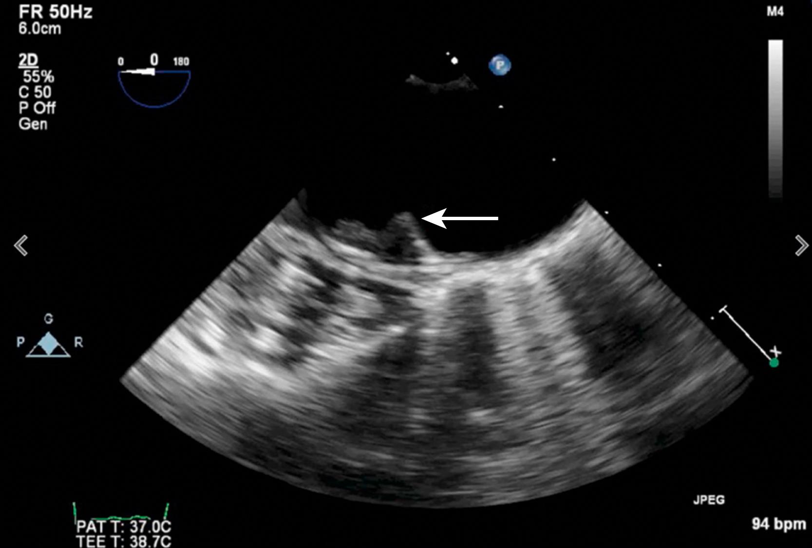 Fig. 32.1, Complex aortic atheroma. A transesophageal echocardiogram showing a sessile plaque protruding from the lesser curvature of the aortic arch into the lumen of the aorta, consistent with complex aortic atheromatous disease.