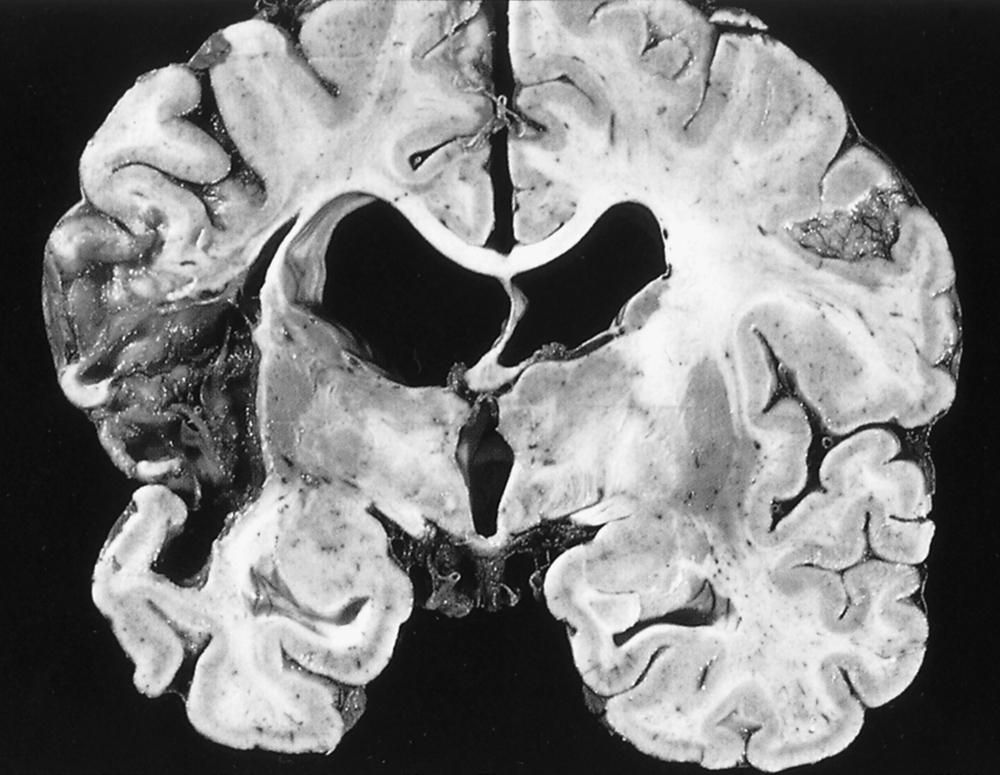 Fig. 32.2, Middle cerebral artery (MCA) territory infarction. A complete MCA territory infarction due to stem occlusion is common in embolic stroke.