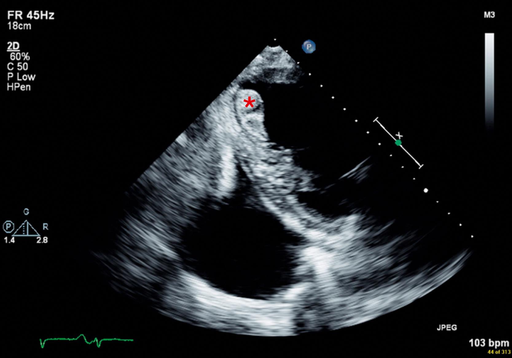Fig. 32.3, Left ventricular apical clot. Large thrombus (star) adherent to the distal inferolateral wall and apical lateral segment in a patient with a cardiomyopathy.