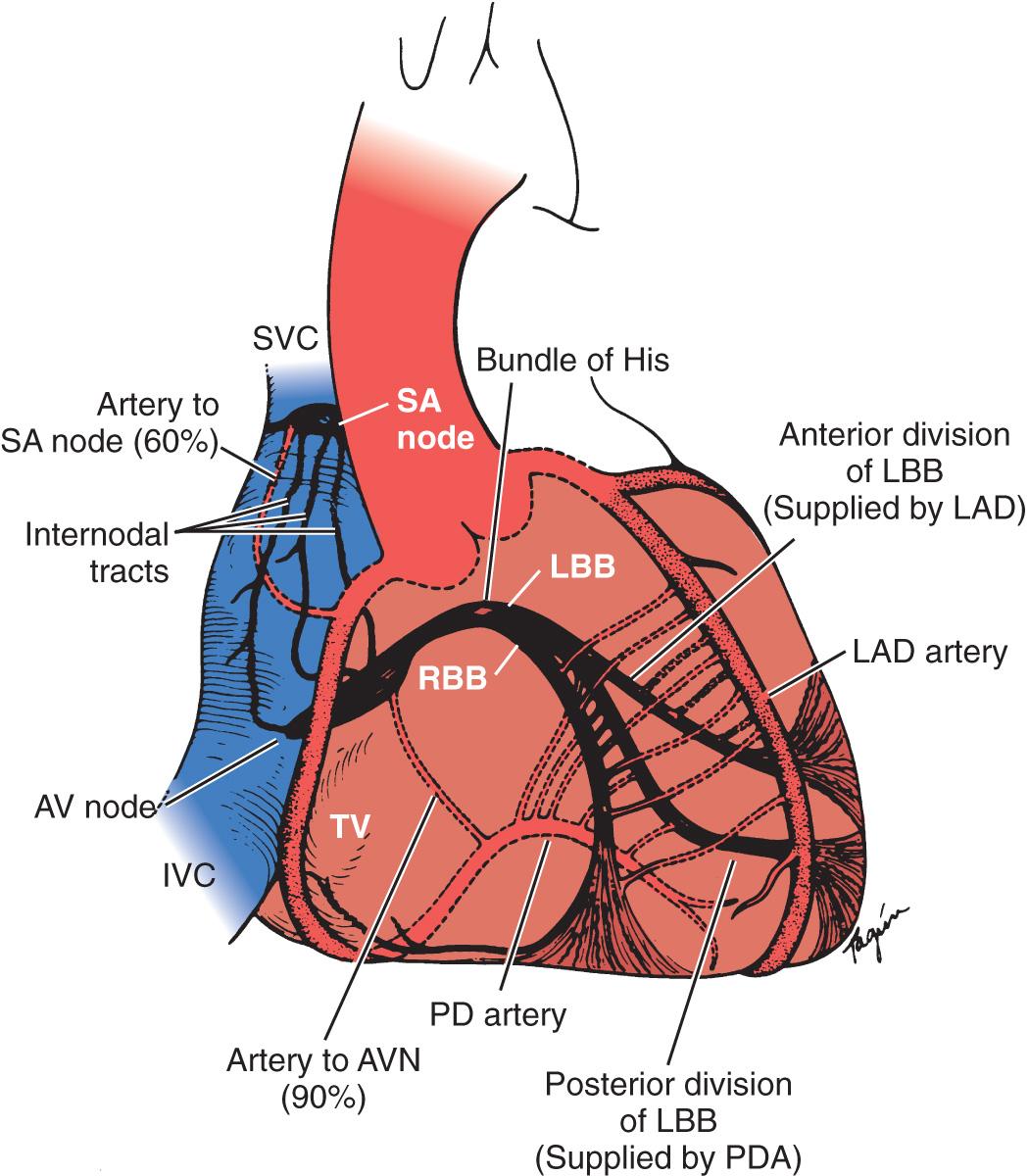 Fig. 3.1, Anatomy of the cardiac conduction system and arterial blood supply. In 60% of patients, the sinoatrial (SA) nodal artery is a branch of the right coronary artery, and in the remainder, it arises from the circumflex artery. The atrioventricular (AV) node is supplied by a branch from the right coronary artery or posterior descending artery (PD artery) . IVC , Inferior vena cava; LAD , left anterior descending coronary artery; LBB , left bundle branch; RBB , right bundle branch; SVC , superior vena cava; TV , tricuspid valve.