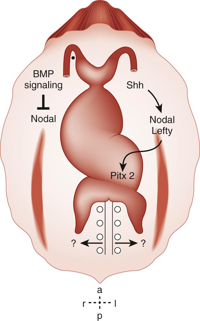 FIGURE 104-2, Molecular determination of the direction of cardiac looping. Summary of the molecular signaling pathways implicated in visceral left-right axis determination and right-handed cardiac looping. BMP, Bone morphogenetic protein; Shh, sonic hedgehog.