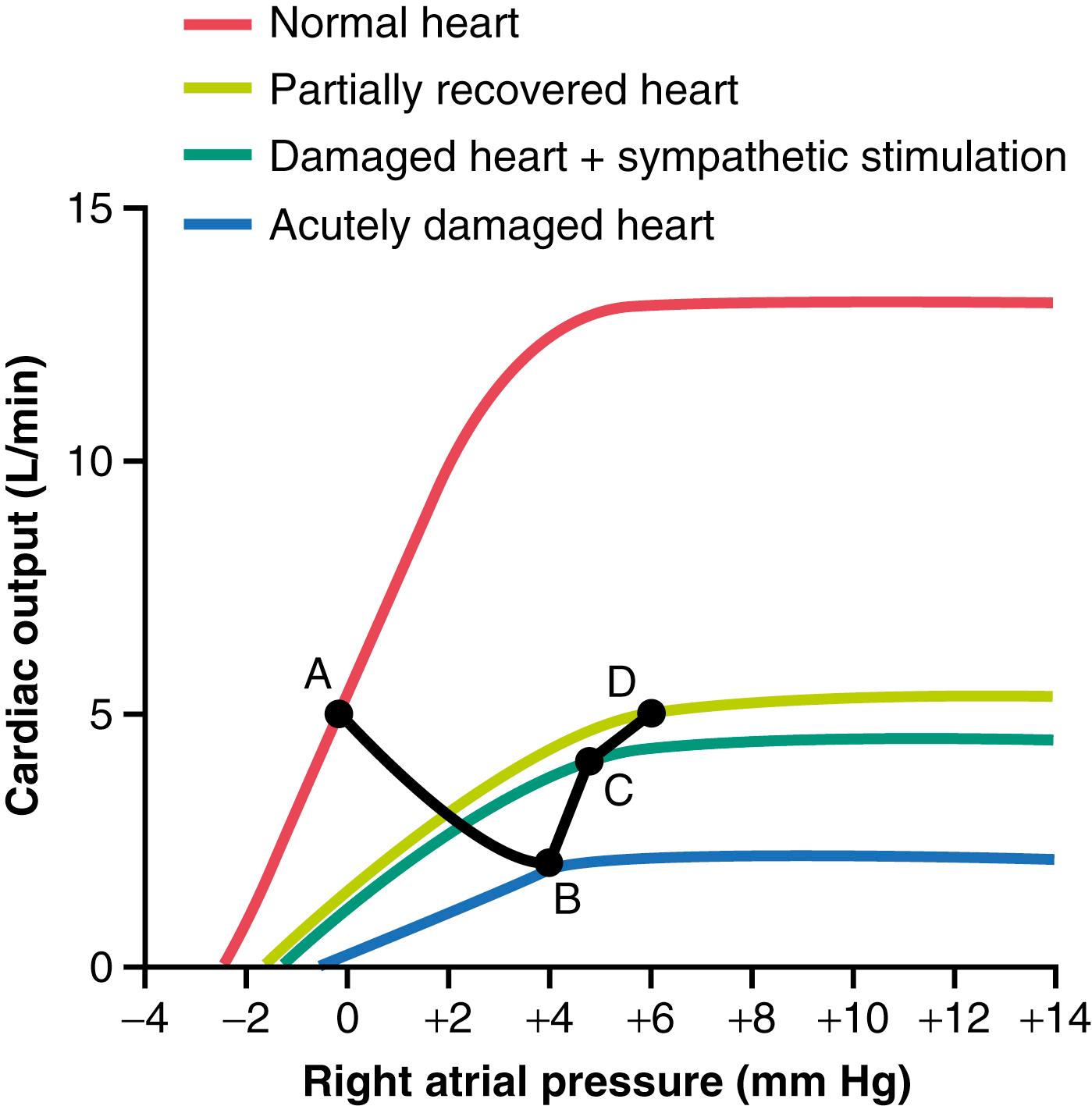 Figure 22-1, Progressive changes in the cardiac output curve after acute myocardial infarction. Both the cardiac output and right atrial pressure change progressively from point A to point D (illustrated by the black line ) over a period of seconds, minutes, days, and weeks.