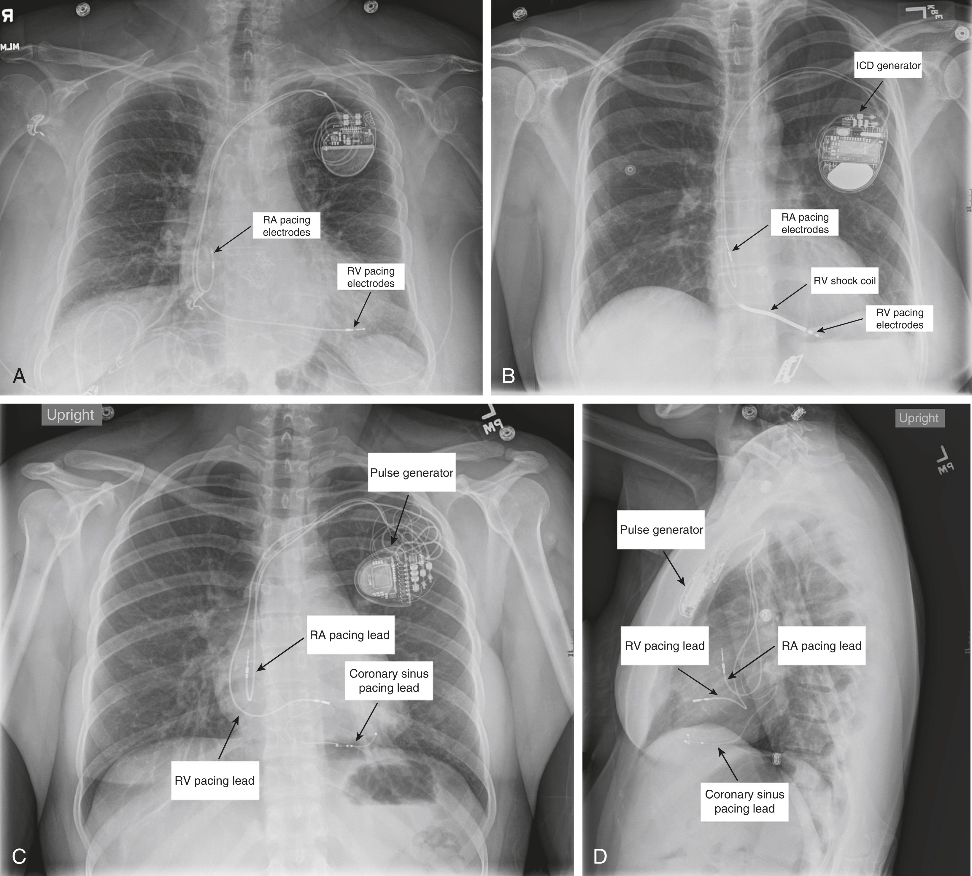 Figure 3.1, (A) Boston Scientific dual-chamber transvenous pacemaker is shown. This patient presented with coronavirus disease 2019 pneumonia and new complete heart block. (B) Medtronic dual-chamber transvenous implantable cardioverter defibrillator (ICD) is shown. This patient had an out of hospital cardiac arrest secondary to monomorphic ventricular tachycardia, and subsequently had this ICD placed for secondary prevention of sudden cardiac death. (C) Medtronic cardiac resynchronization therapy pacemaker (CRT-P) is shown. This patient had atrioventricular node dysfunction and a high right ventricular pacing burden. The lead in a branch of the coronary sinus vein (ie middle cardiac vein) is used to pace the left ventricle. The absence of a shock coil identifies this device as a CRT-P as opposed to cardiac resynchronization therapy defibrillator (CRT-D). (D) Lateral view of the same Medtronic cardiac resynchronization therapy pacemaker (CRT-P) is shown.