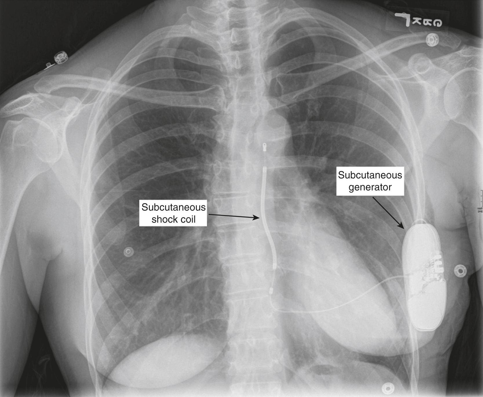 Figure 3.2, Boston Scientific subcutaneous implantable cardioverter defibrillator (S-ICD) is shown. This patient initially had a transvenous ICD placed for secondary prevention. The transvenous ICD was then extracted because of a lead malfunction and replaced with this S-ICD. The S-ICD cannot deliver antitachycardia pacing (ATP), and has very limited antibradycardia pacing (ie it paces for approximately 30 seconds after delivering a shock).