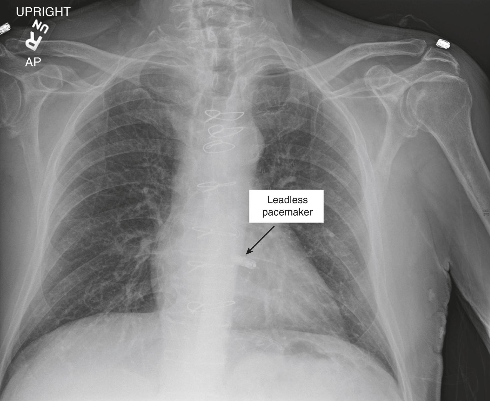 Figure 3.3, Medtronic leadless pacemaker is shown. This patient had sick sinus syndrome and second-degree heart block for which a transvenous pacemaker was initially placed. The transvenous pacemaker then became infected; thus, it was extracted and this leadless pacemaker was ultimately placed. This leadless pacemaker cannot provide atrial pacing and has no magnet response.