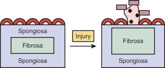 Figure 9.1, Pathogenesis of Infective Endocarditis.