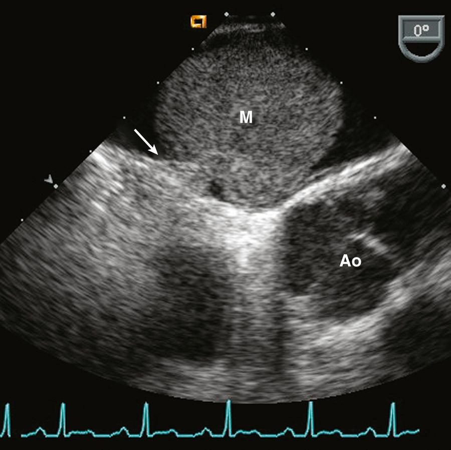 Fig. 15.11, TEE LA myxoma.