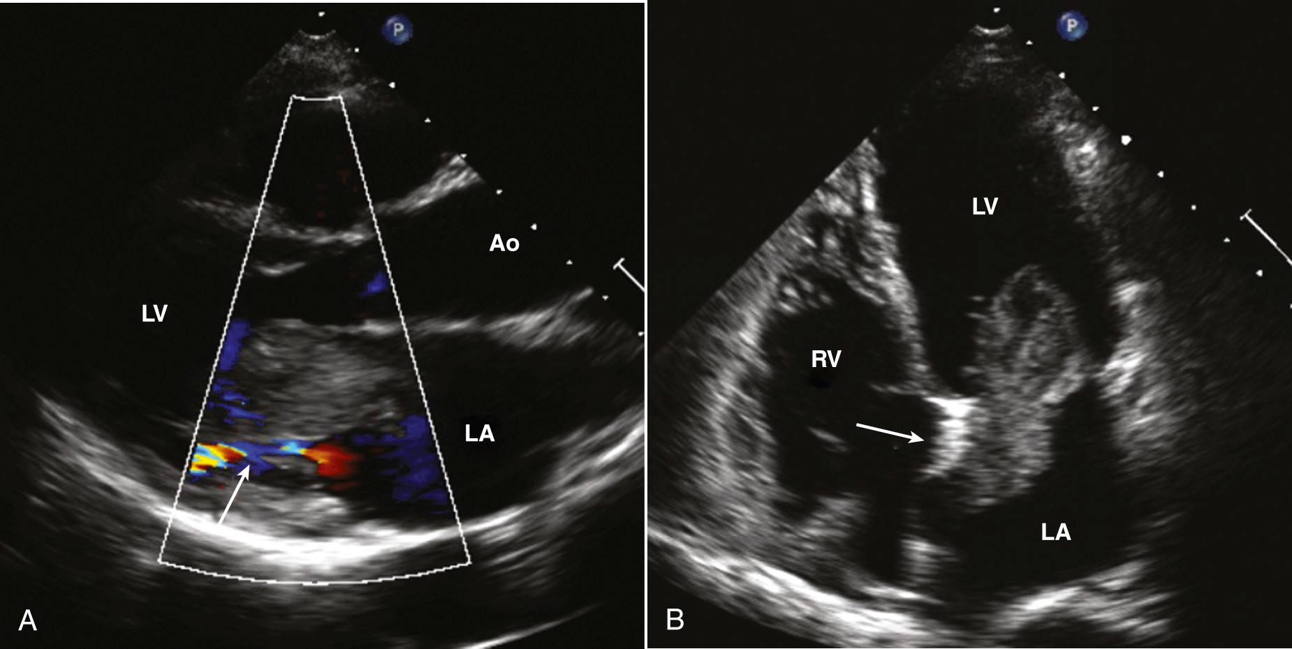 Fig. 15.12, TTE large LA myxoma.