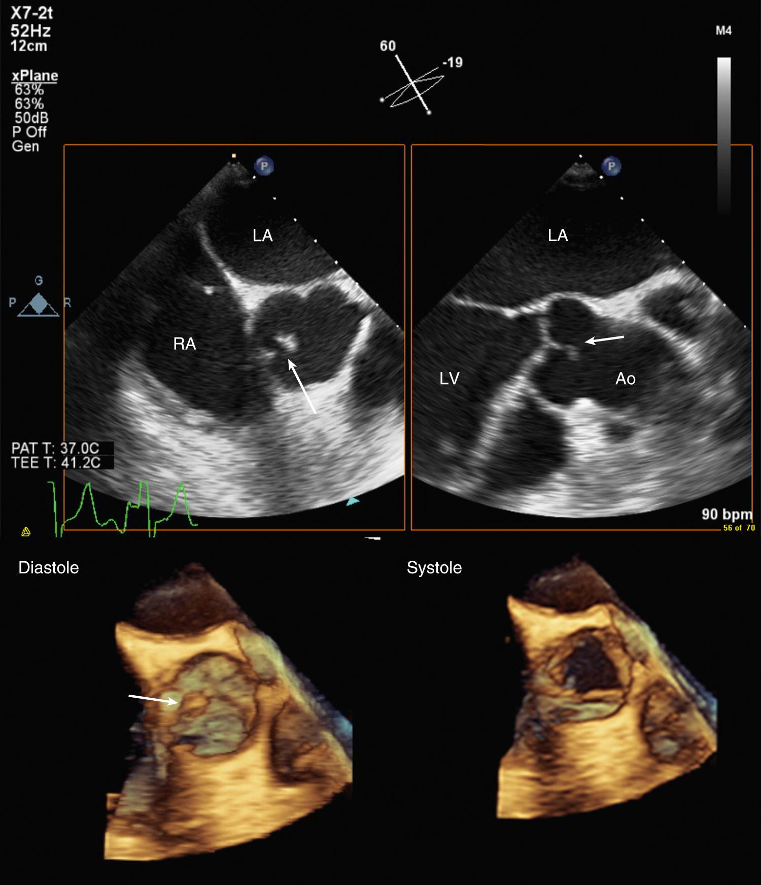 Fig. 15.13, Papillary fibroelastoma on 2D and 3D imaging.