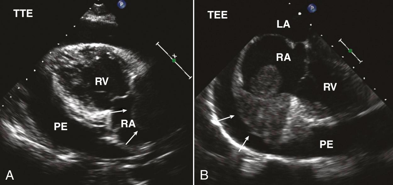 Fig. 15.15, Angiosarcoma.