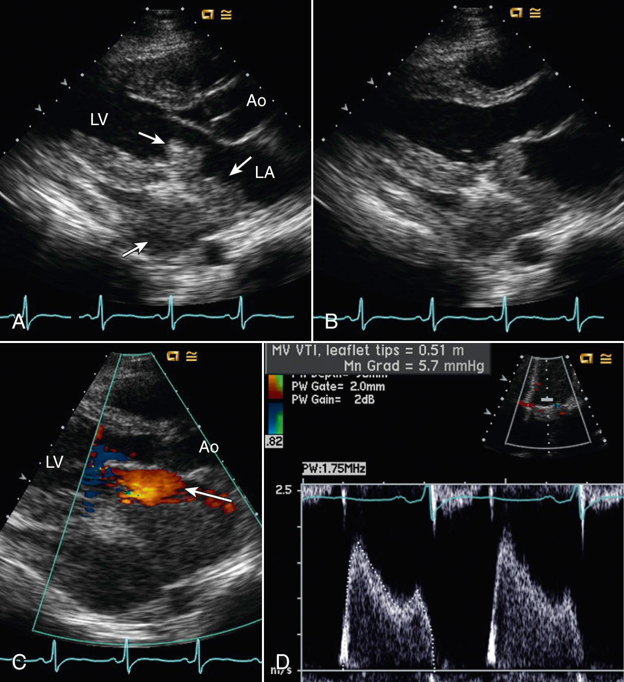 Fig. 15.16, Rhabdomyosarcoma.