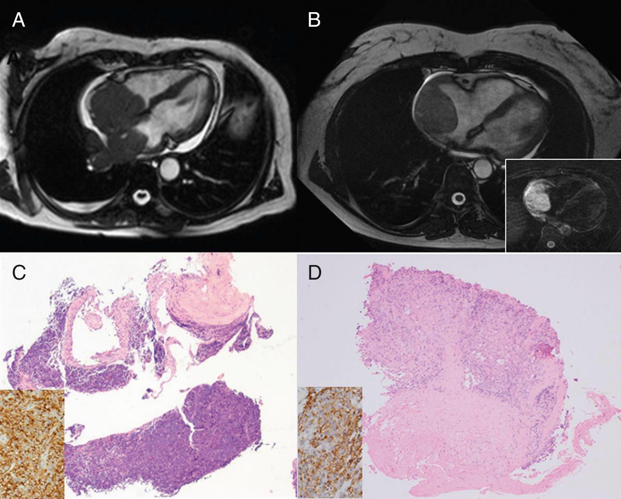 Fig. 15.17, Cardiac magnetic resonance imaging of RA masses.